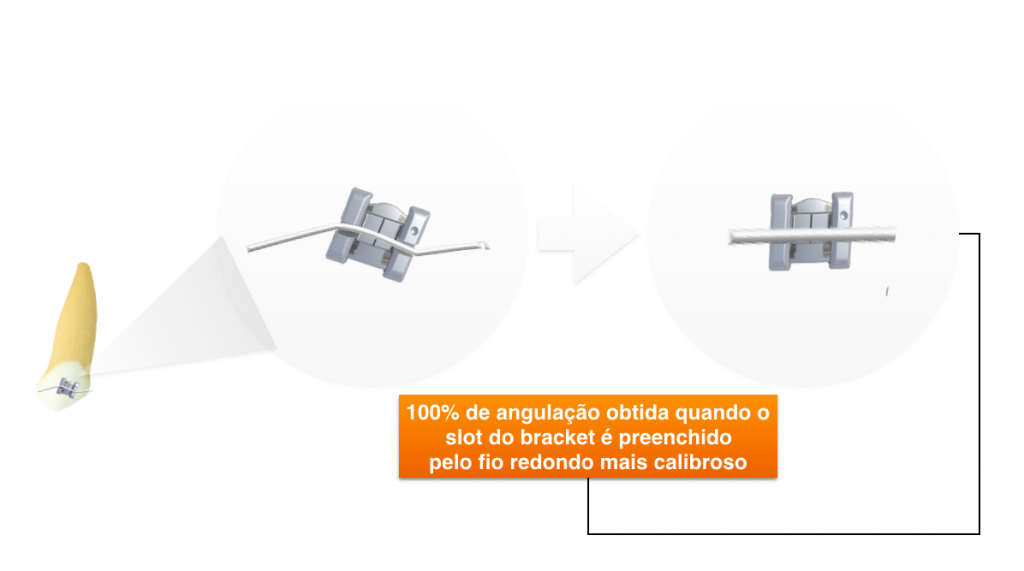 demonstração da máxima angulação do bracket quando o seu slot está preenchido por um fio redondo de maior calibre