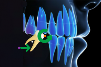 Biomecânica em Ortodontia: 3 maneiras de otimizar o tratamento de seus pacientes